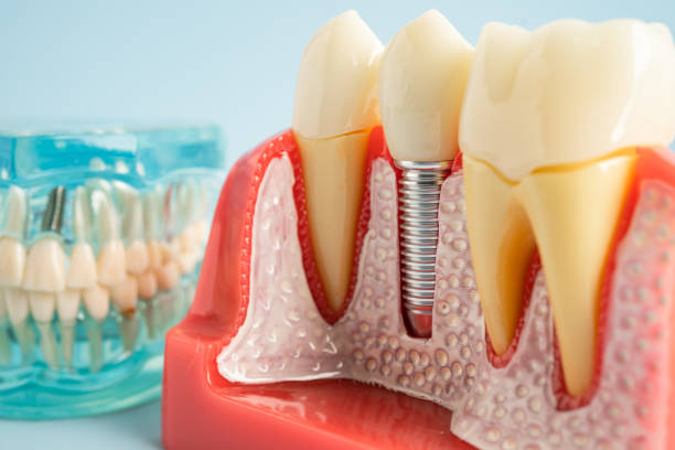 Dental Bonding in Riverside, IL